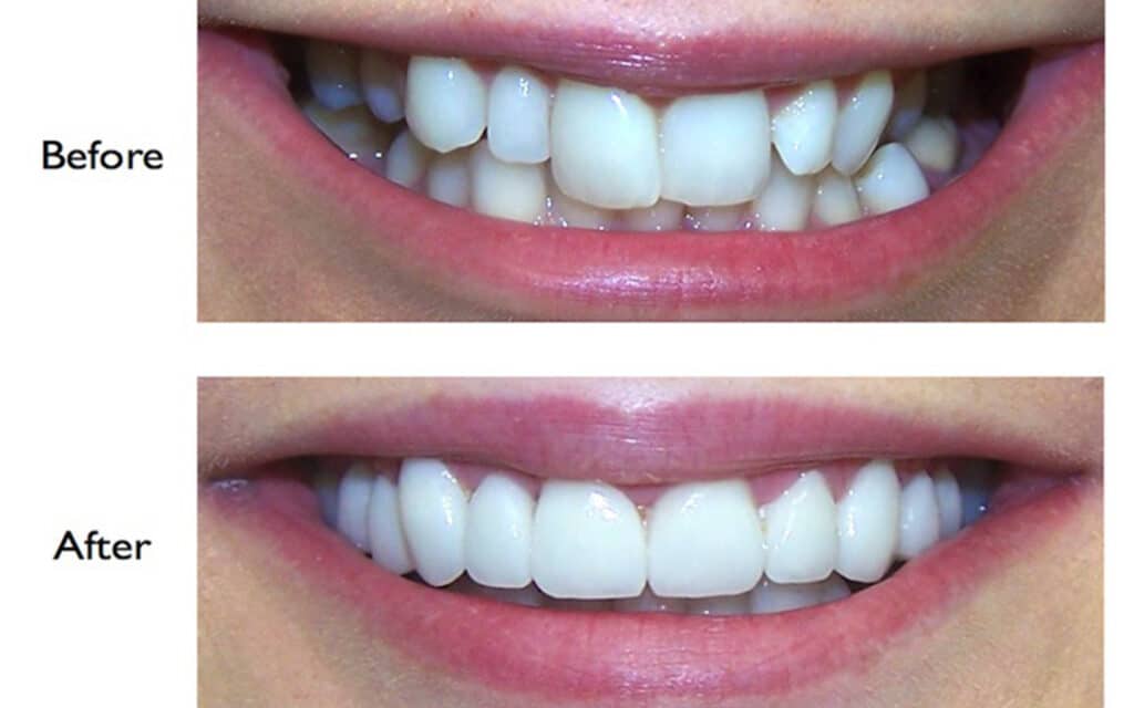 smile-makeover-image-1-1024x640 宏茂桥居民找 AMK 牙医的 4 个行业观察信号